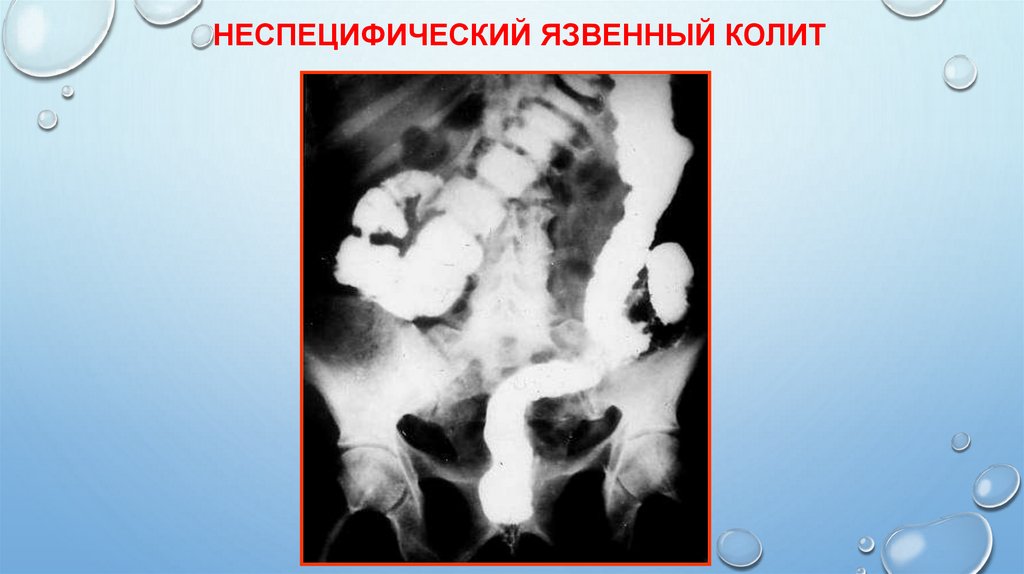 Неспецифический язвенный колит