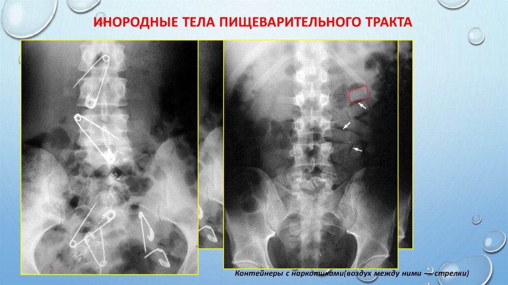 Инородные тела пищеварительного тракта