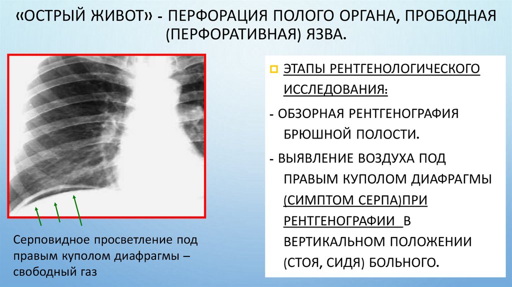 «Острый живот» - перфорация полого органа, прободная (перфоративная) язва.