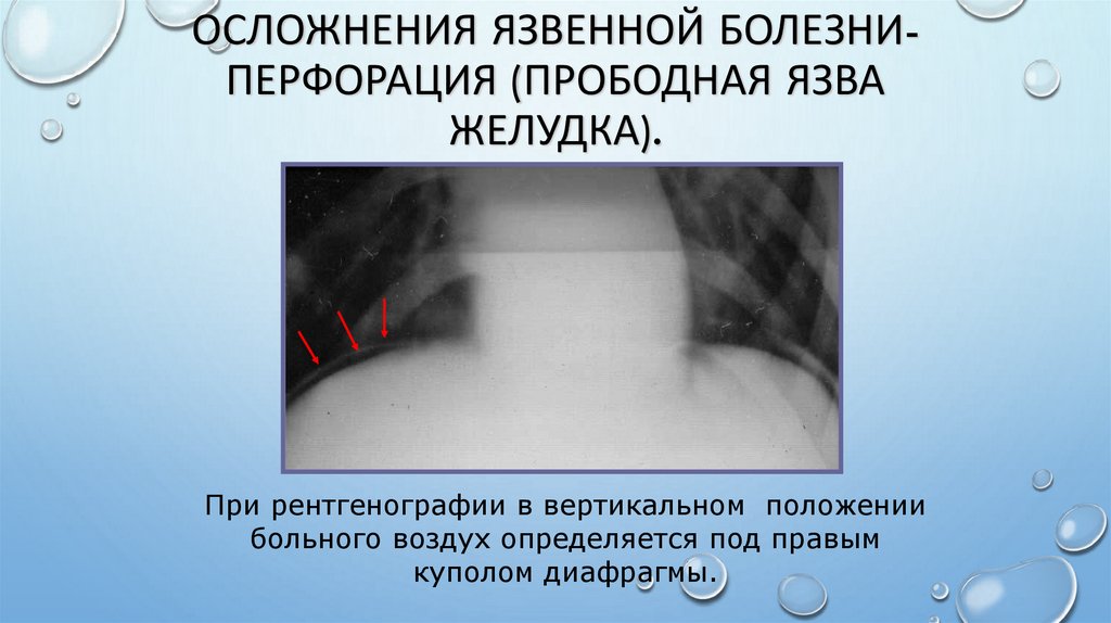 Осложнения язвенной болезни-перфорация (прободная язва желудка).