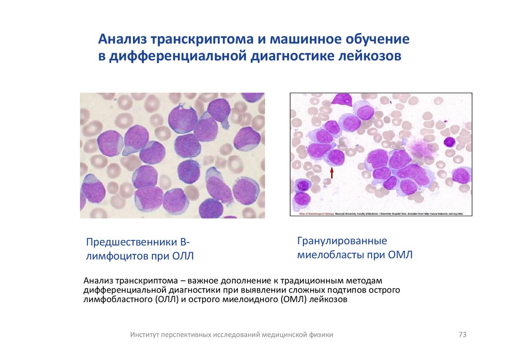 Анализ транскриптома и машинное обучение в дифференциальной диагностике лейкозов