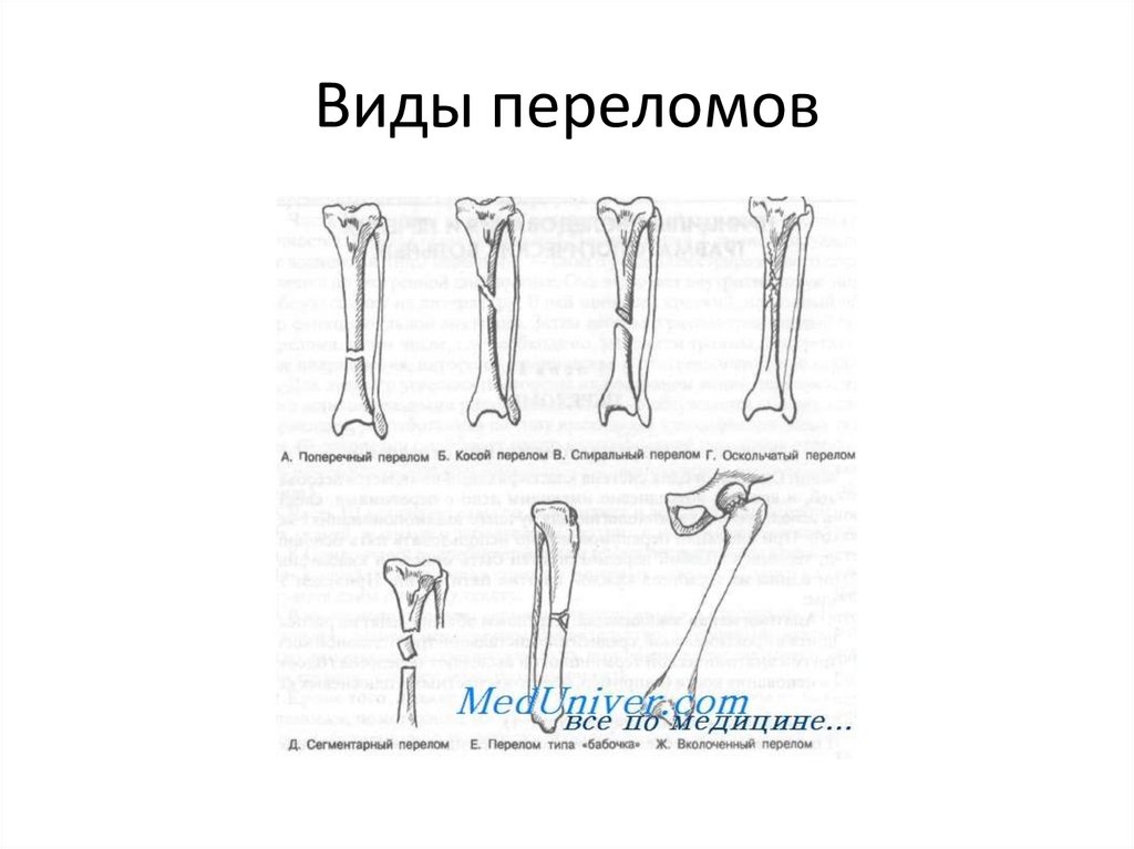 Виды переломов