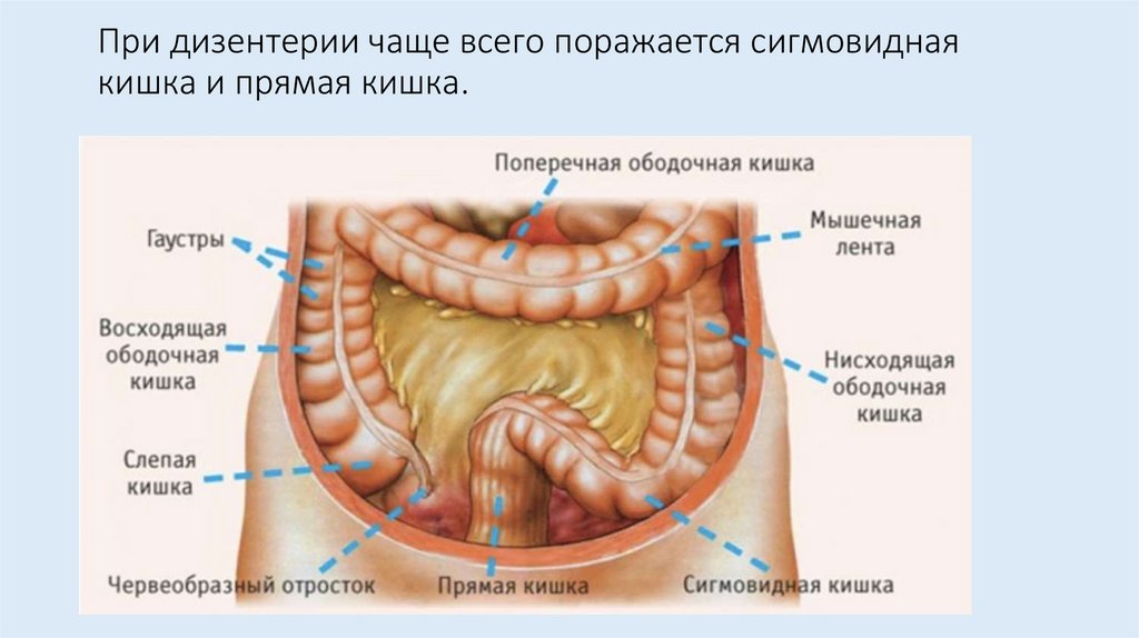 При дизентерии чаще всего поражается сигмовидная кишка и прямая кишка.