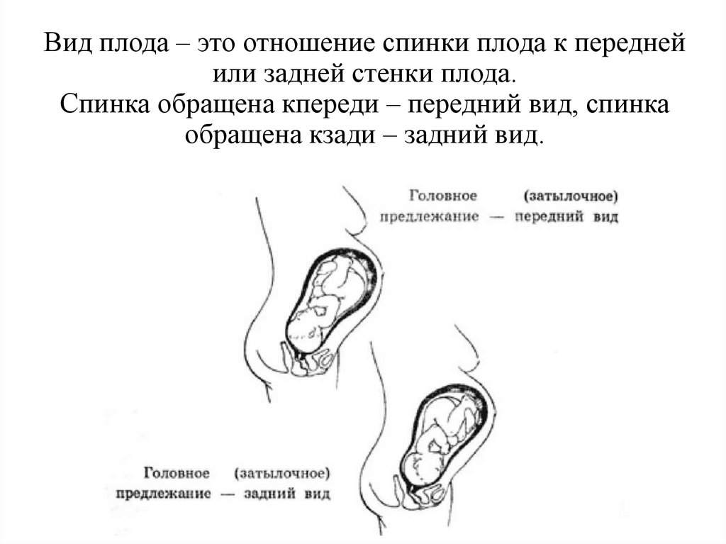 Вид плода – это отношение спинки плода к передней или задней стенки плода. Спинка обращена кпереди – передний вид, спинка