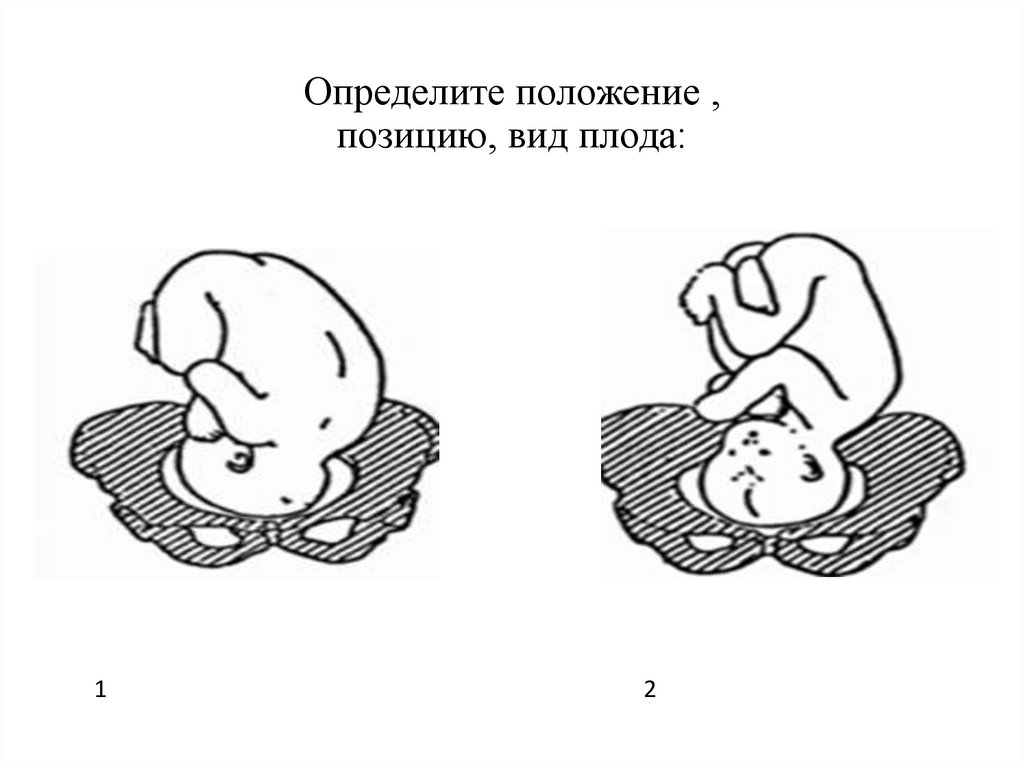 Определите положение , позицию, вид плода:
