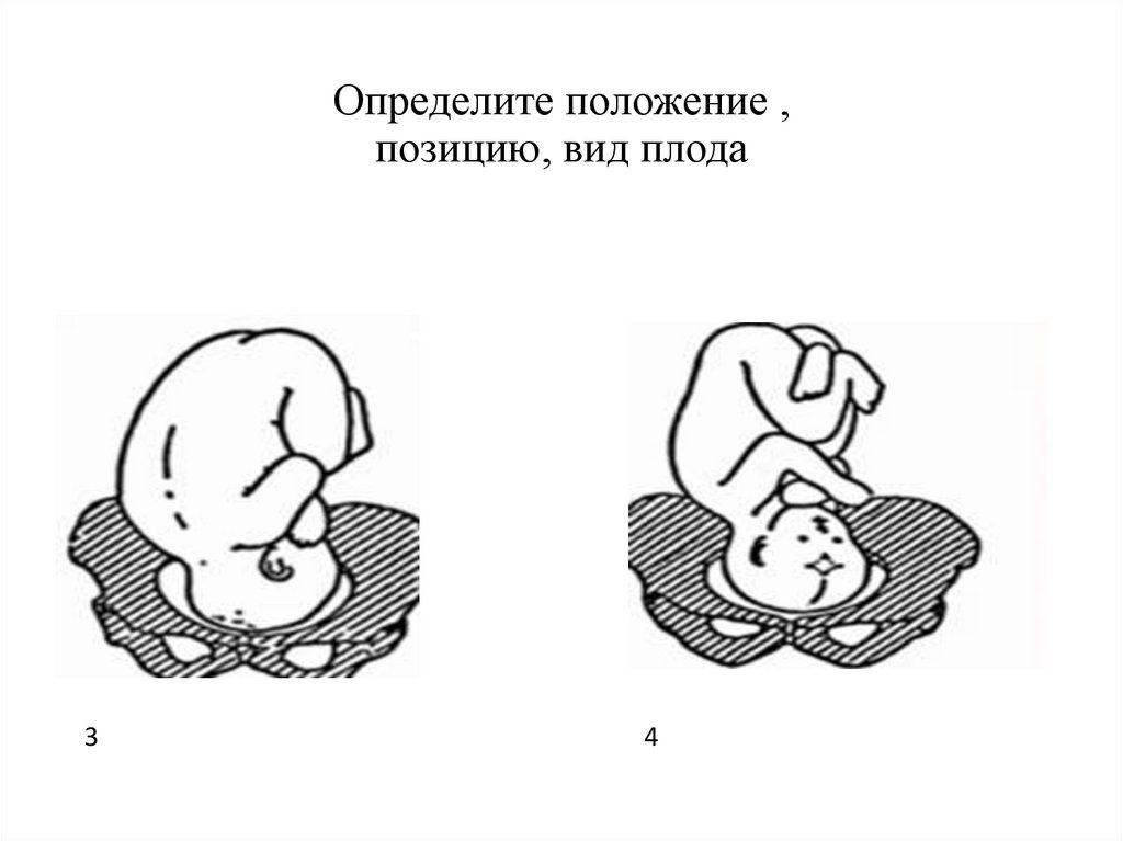 Определите положение , позицию, вид плода