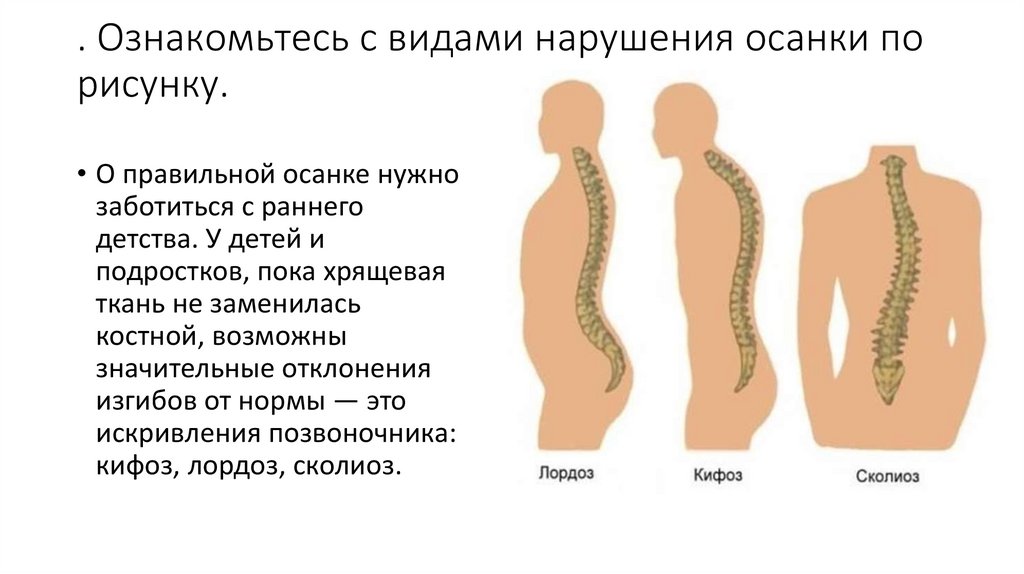 . Ознакомьтесь с видами нарушения осанки по рисунку.