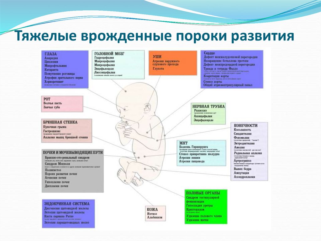 Тяжелые врожденные пороки развития