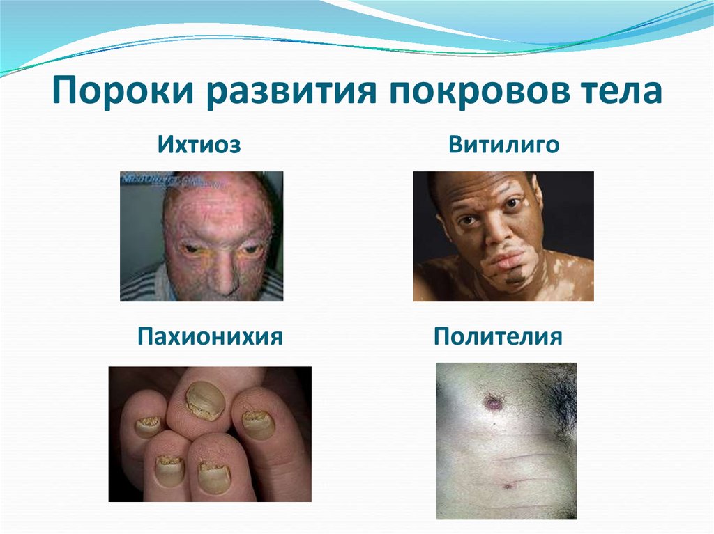 Пороки развития покровов тела