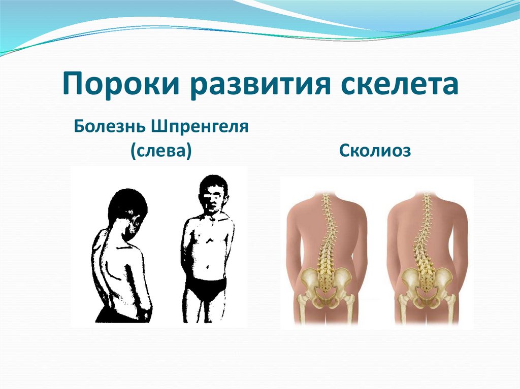 Пороки развития скелета