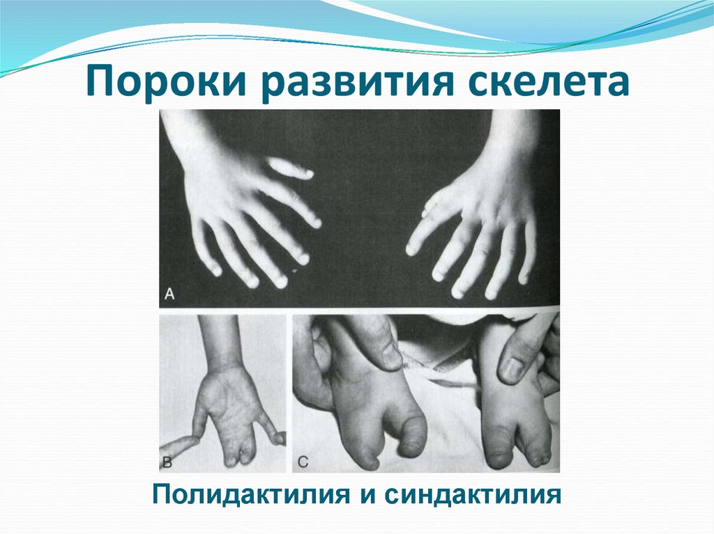 Пороки развития скелета