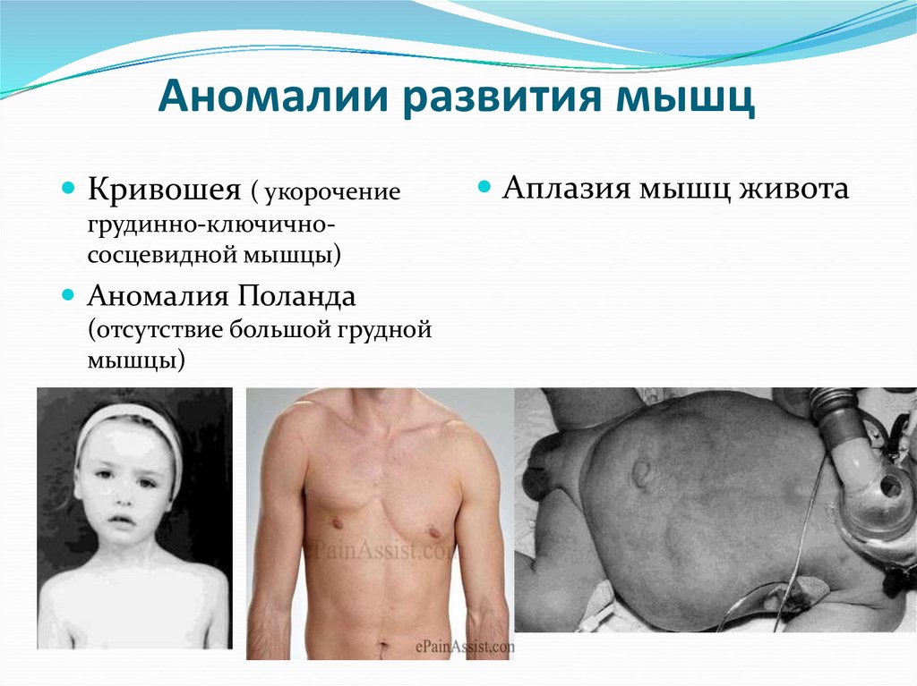 Аномалии развития мышц