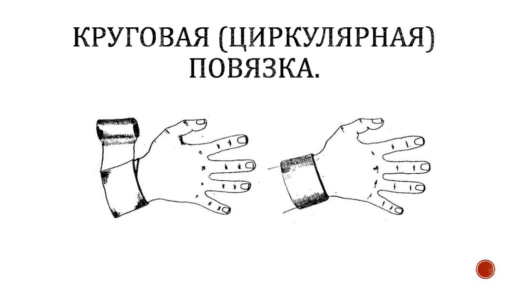 Круговая (циркулярная) повязка.
