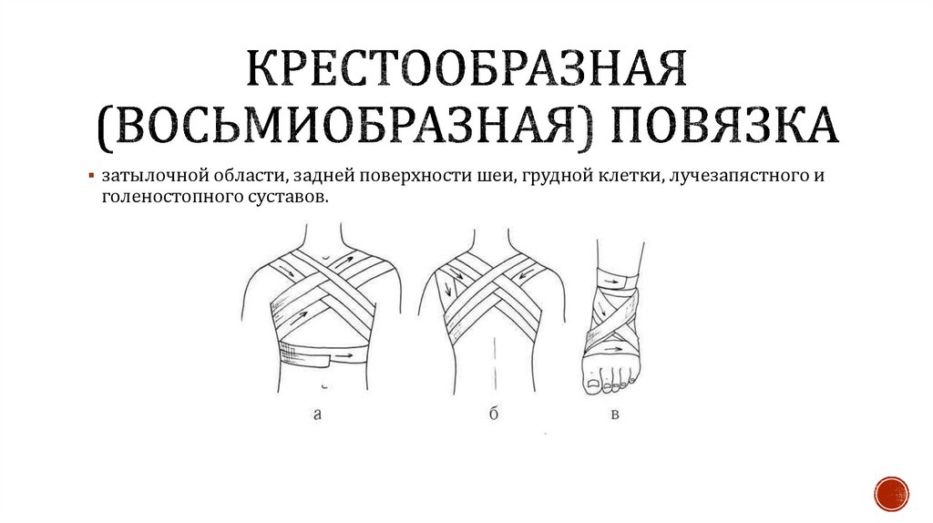 Крестообразная (восьмиобразная) повязка