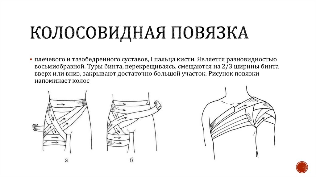 Колосовидная повязка