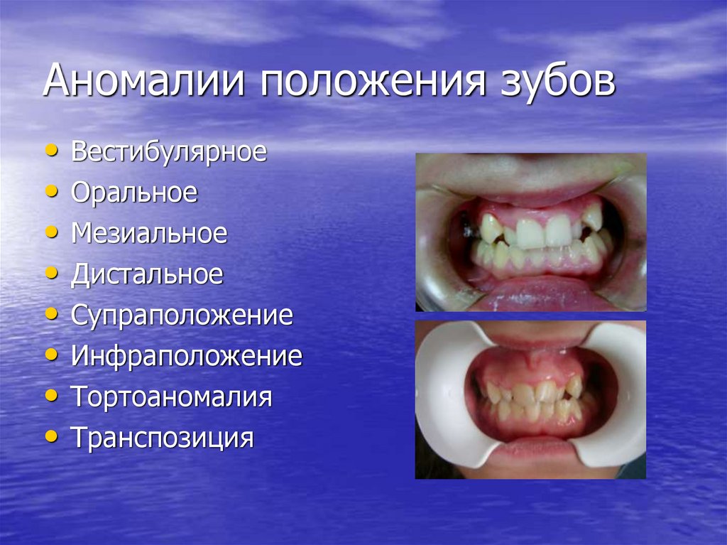 Аномалии положения зубов