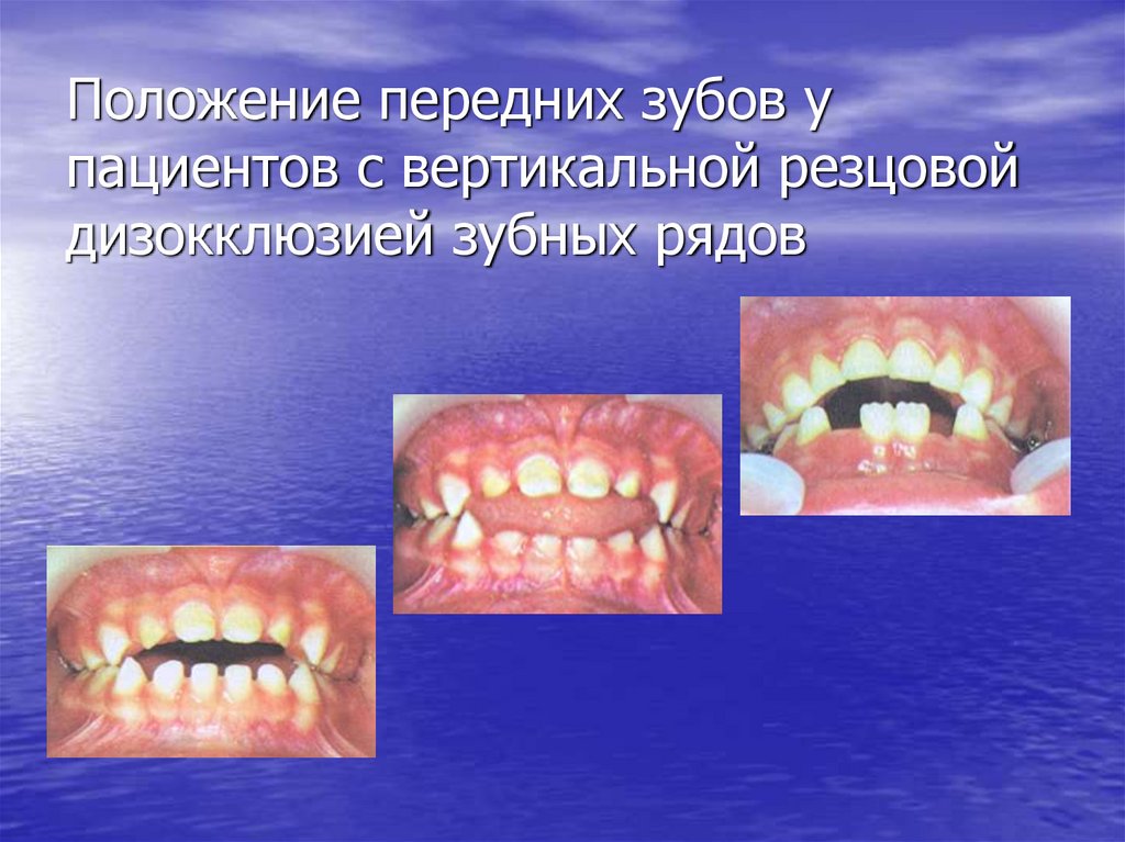 Положение передних зубов у пациентов с вертикальной резцовой дизокклюзией зубных рядов