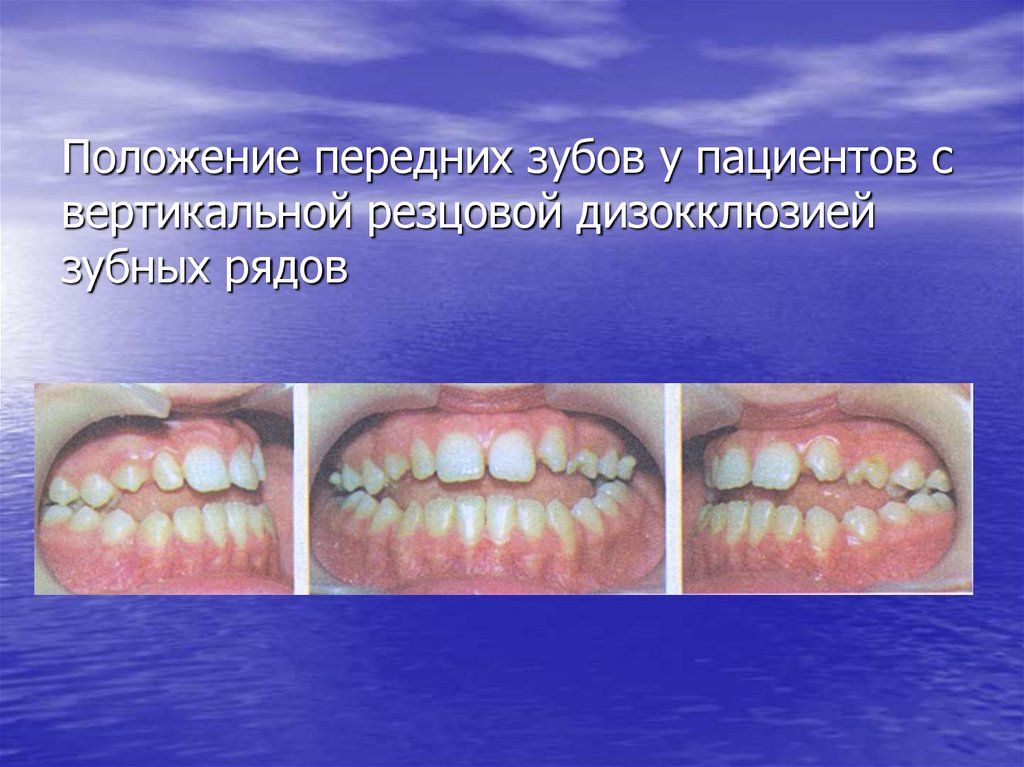 Положение передних зубов у пациентов с вертикальной резцовой дизокклюзией зубных рядов