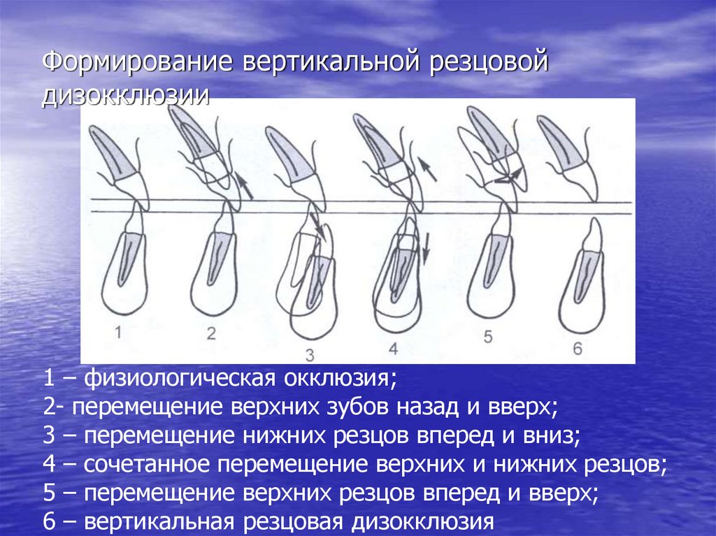 Формирование вертикальной резцовой дизокклюзии
