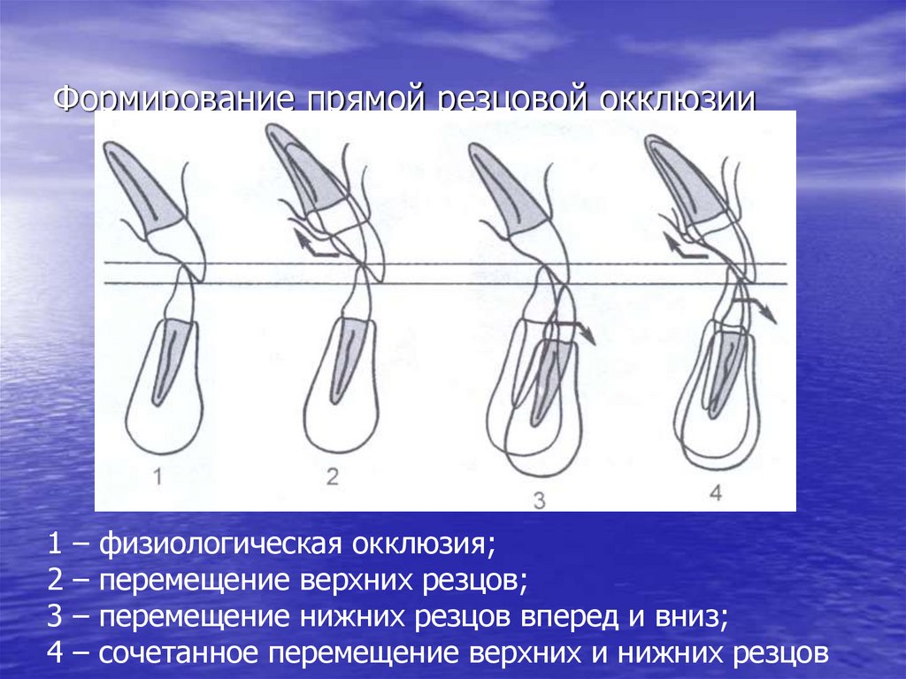 Формирование прямой резцовой окклюзии