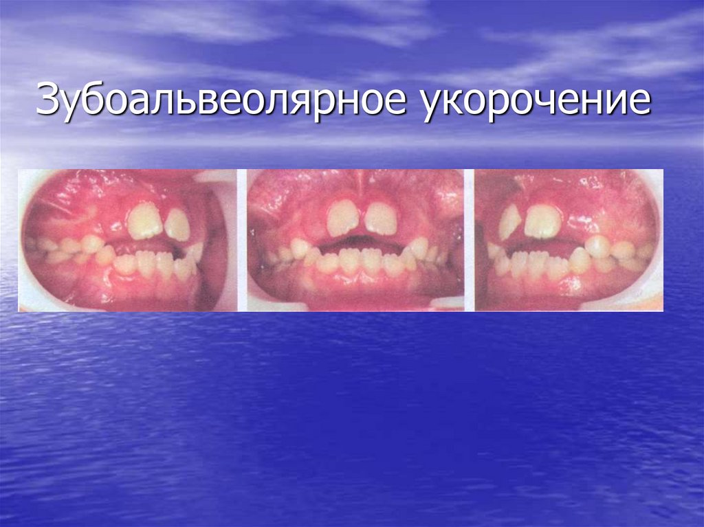 Зубоальвеолярное укорочение