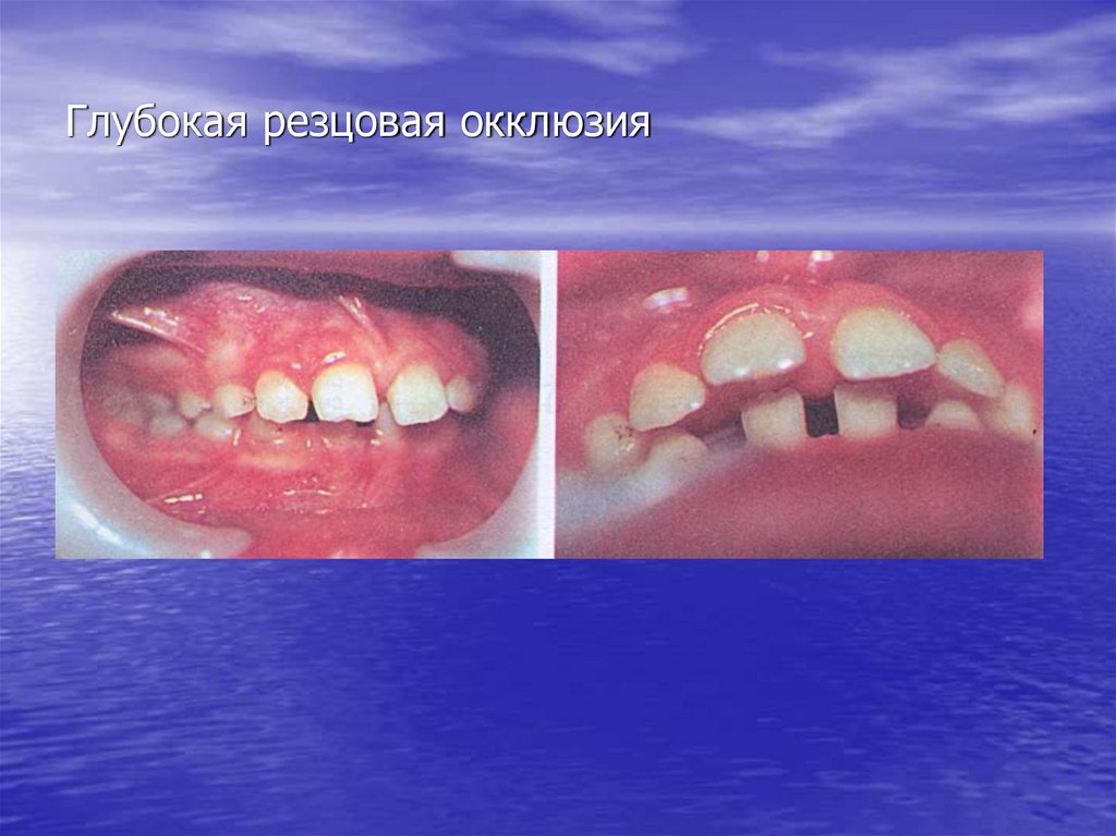 Глубокая резцовая окклюзия