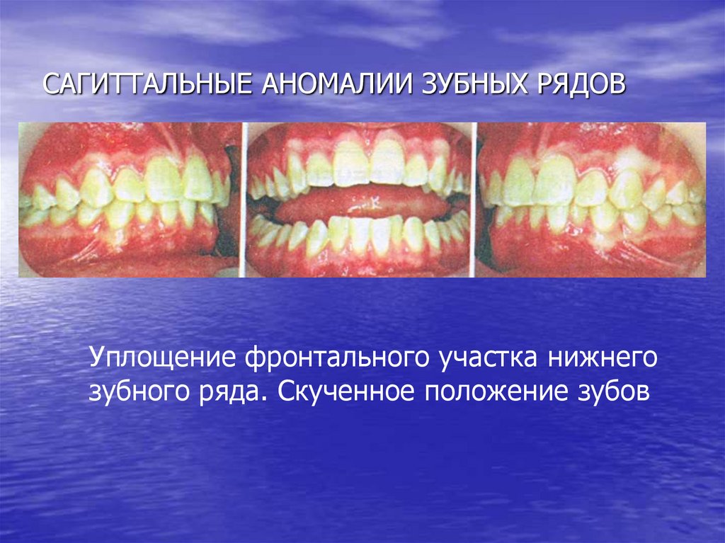САГИТТАЛЬНЫЕ АНОМАЛИИ ЗУБНЫХ РЯДОВ