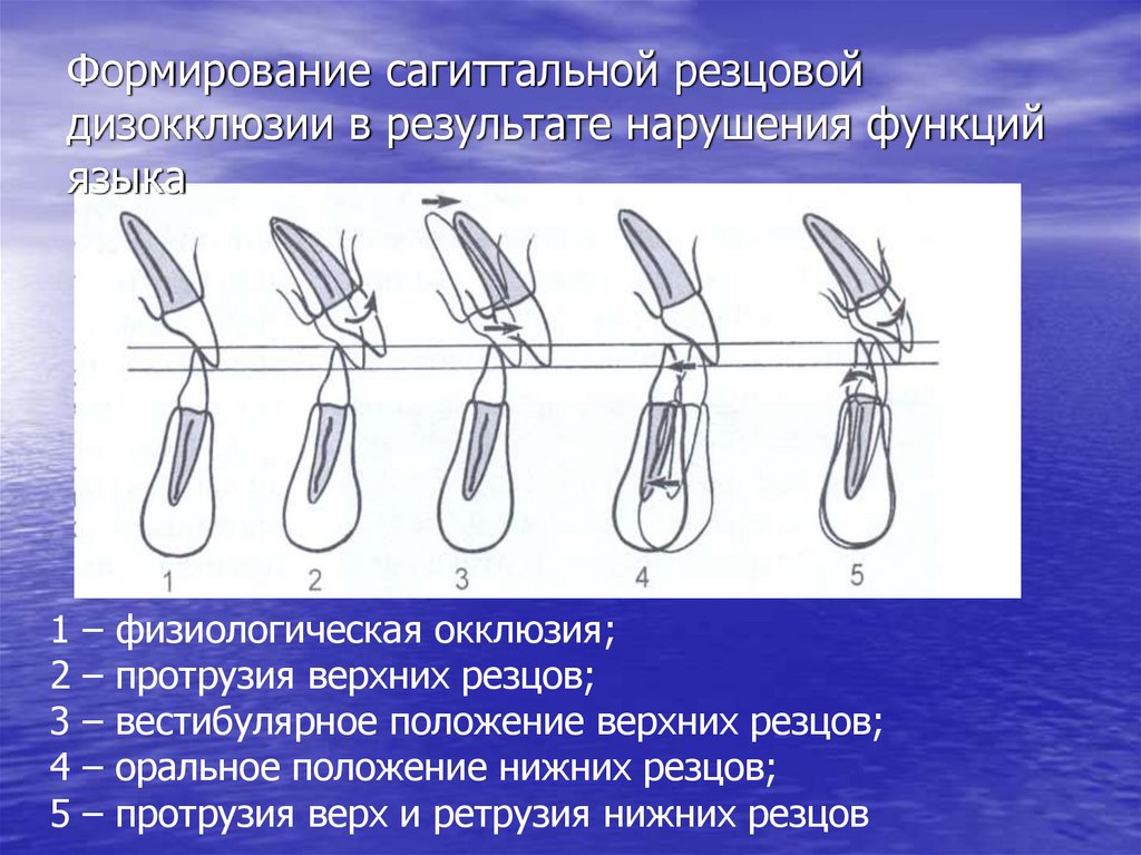 Формирование сагиттальной резцовой дизокклюзии в результате нарушения функций языка