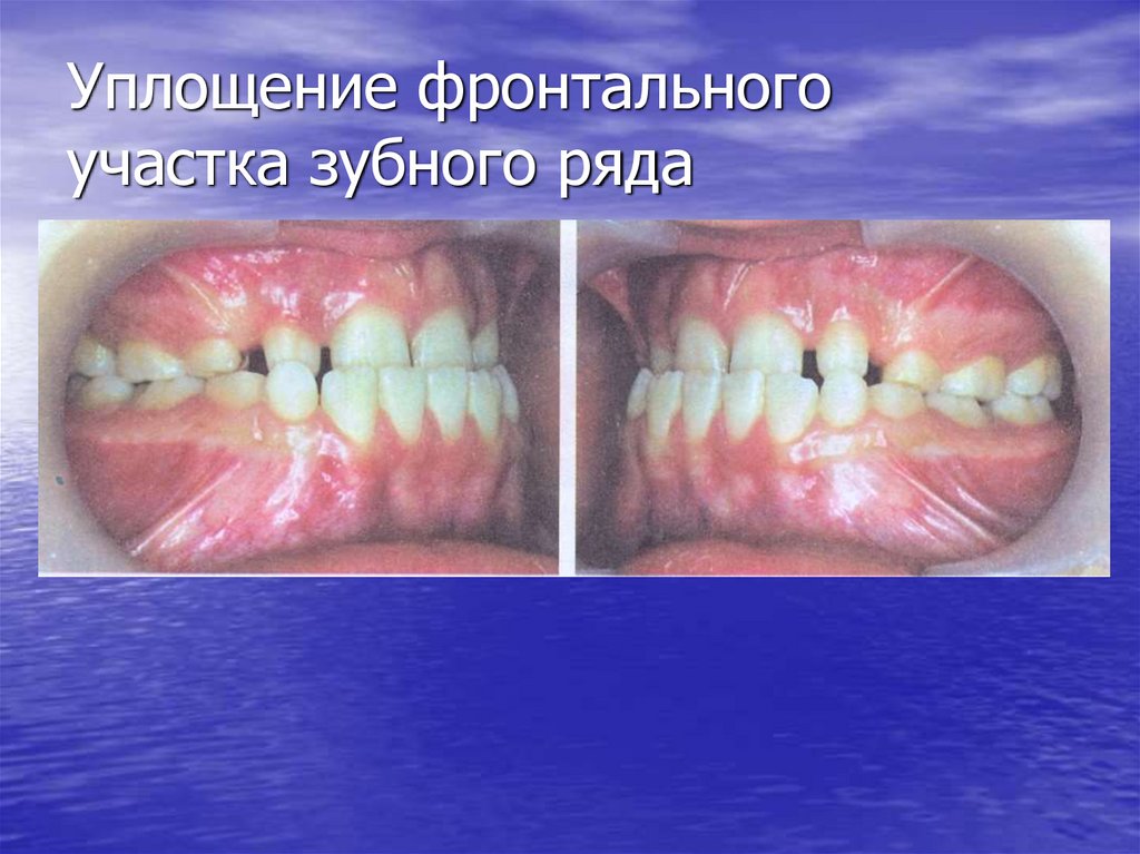 Уплощение фронтального участка зубного ряда