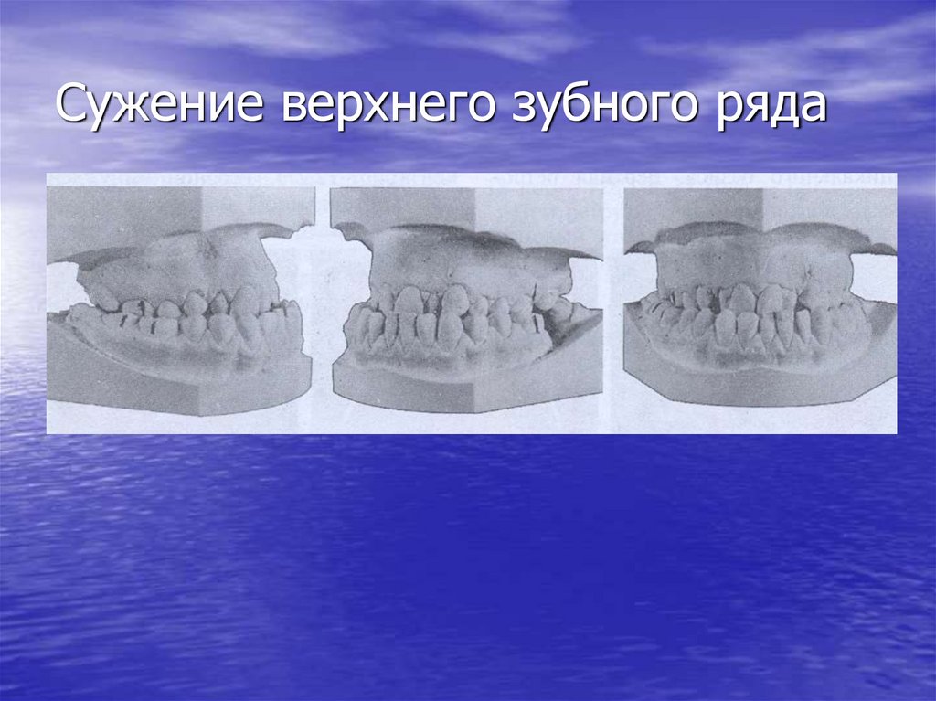 Сужение верхнего зубного ряда