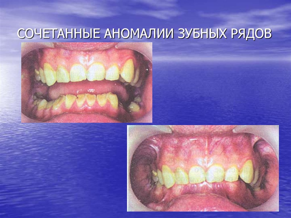 СОЧЕТАННЫЕ АНОМАЛИИ ЗУБНЫХ РЯДОВ