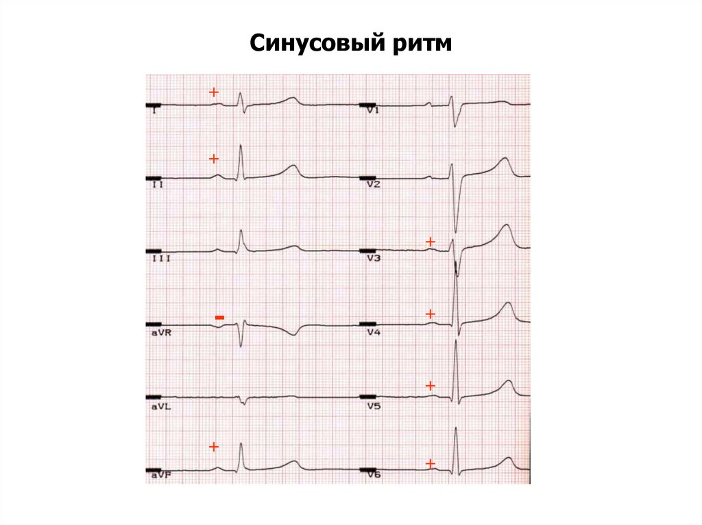 Синусовый ритм