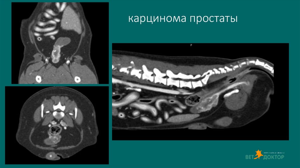 карцинома простаты