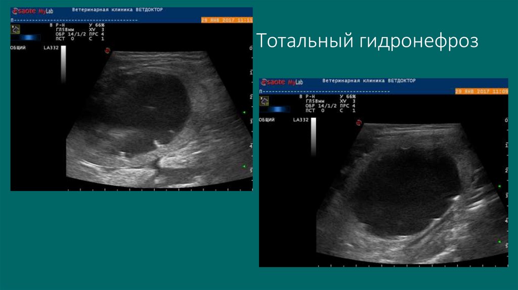 Тотальный гидронефроз