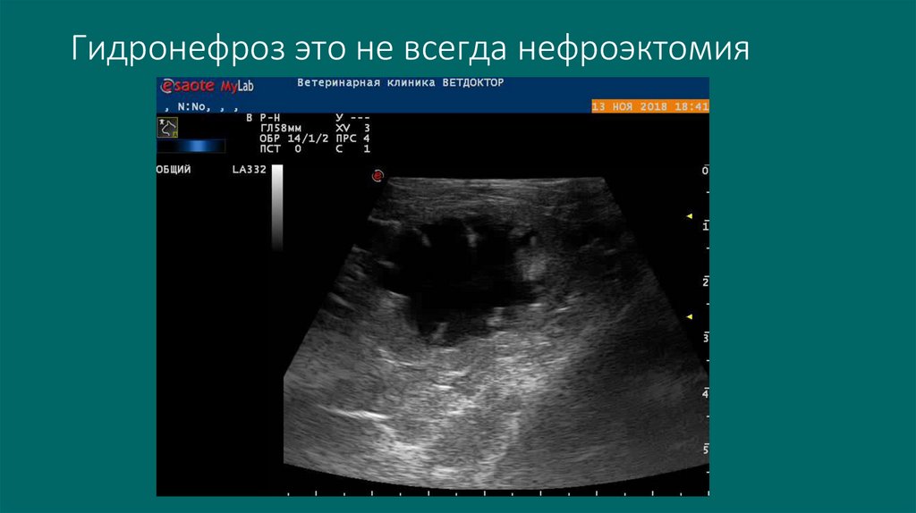 Гидронефроз это не всегда нефроэктомия