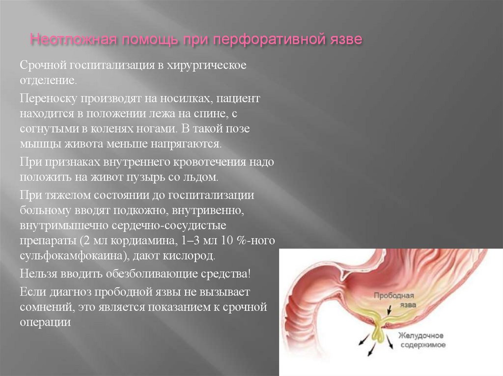 Неотложная помощь при перфоративной язве