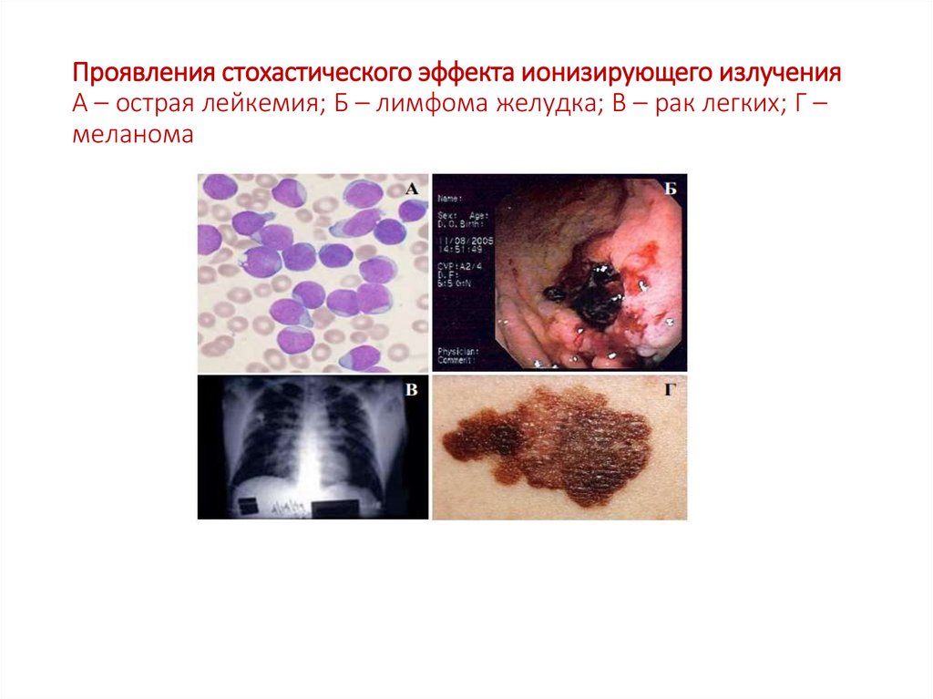 Проявления стохастического эффекта ионизирующего излучения А – острая лейкемия; Б – лимфома желудка; В – рак легких; Г –