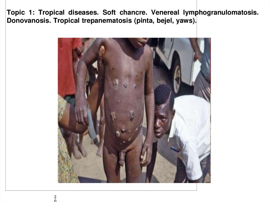 Primary lesions of Yaws