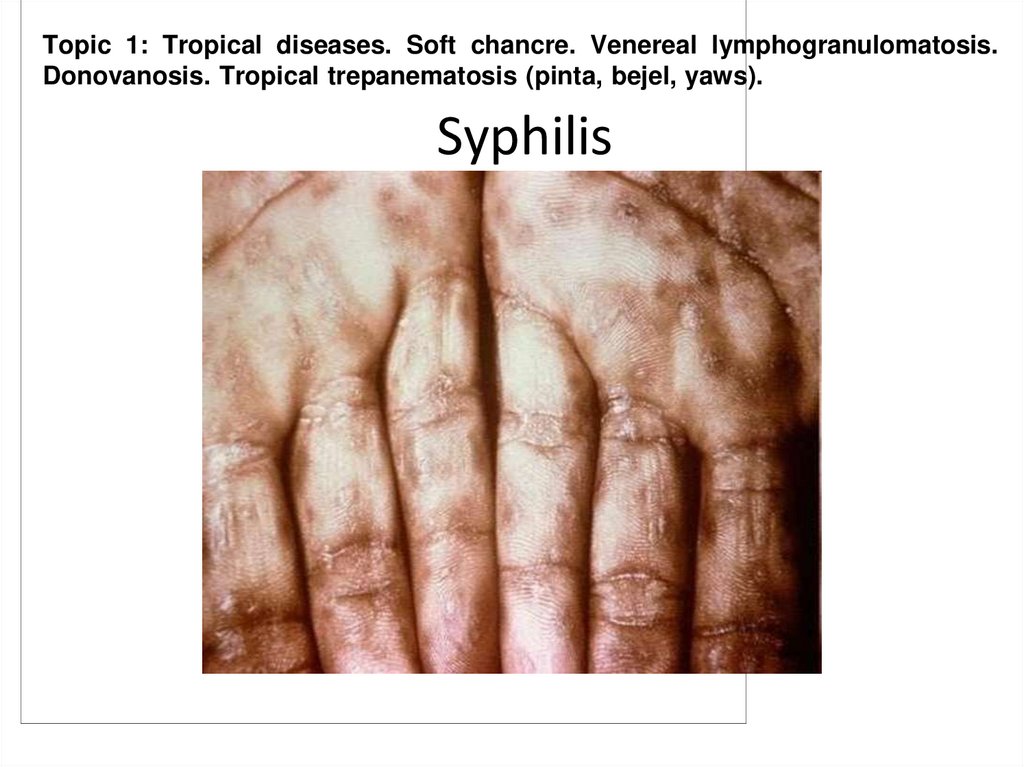Syphilis