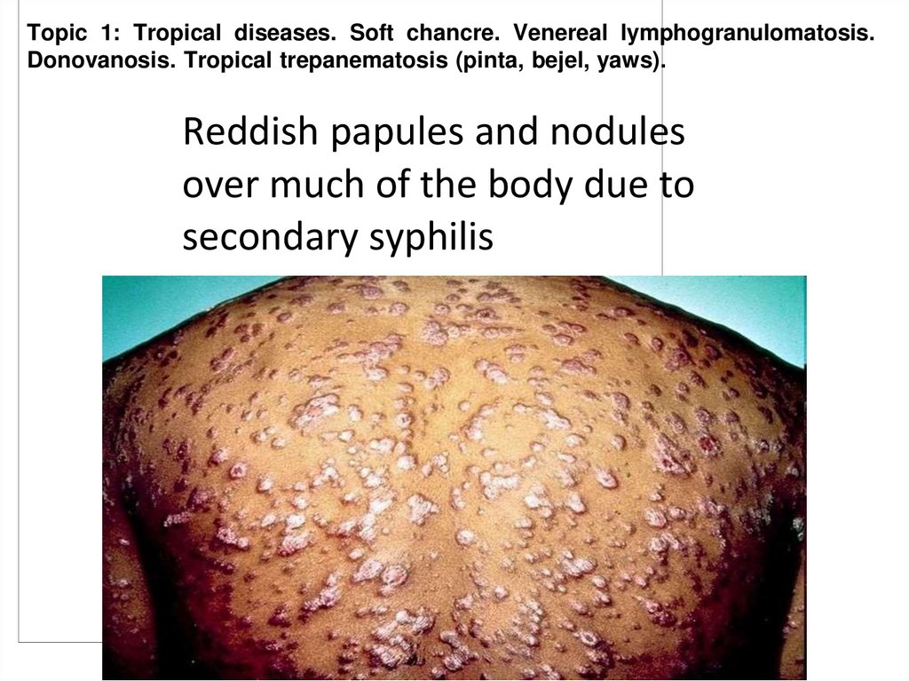 Reddish papules and nodules over much of the body due to secondary syphilis