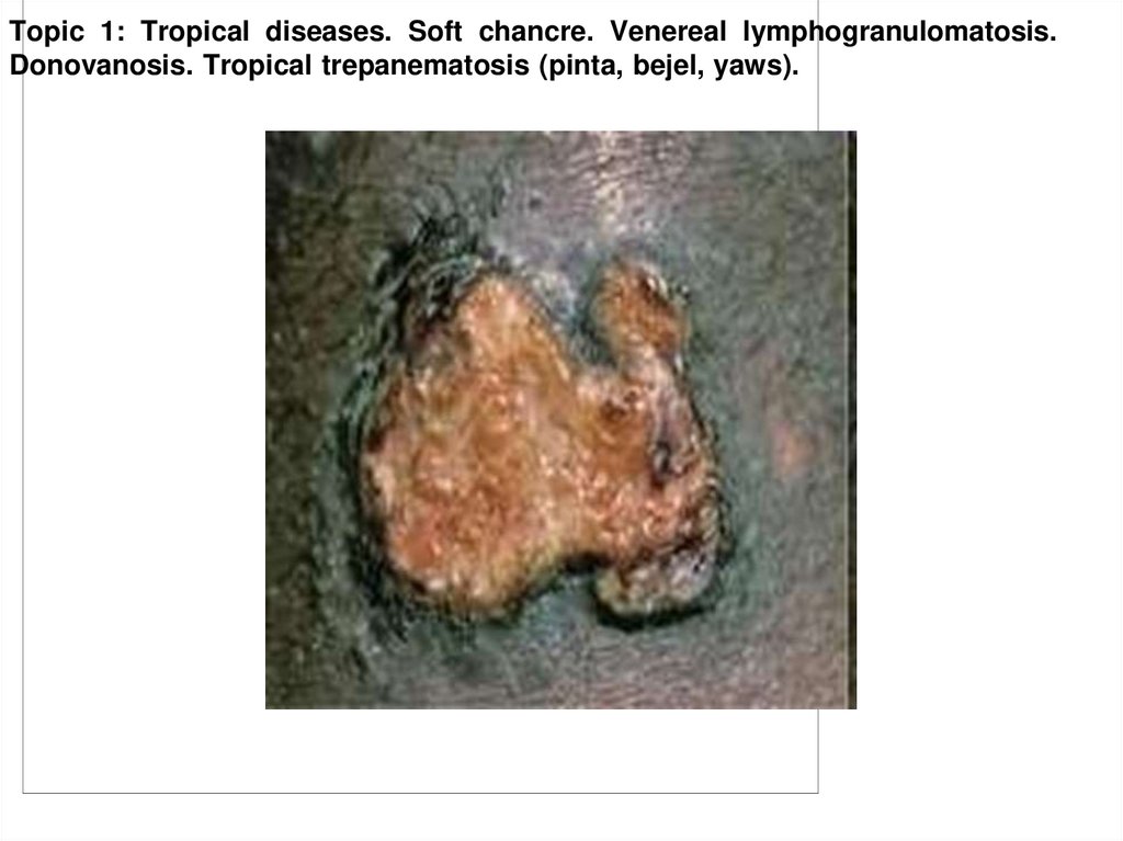 Skin lesion in Bejel