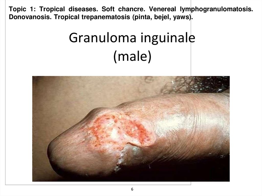 Granuloma inguinale (male)