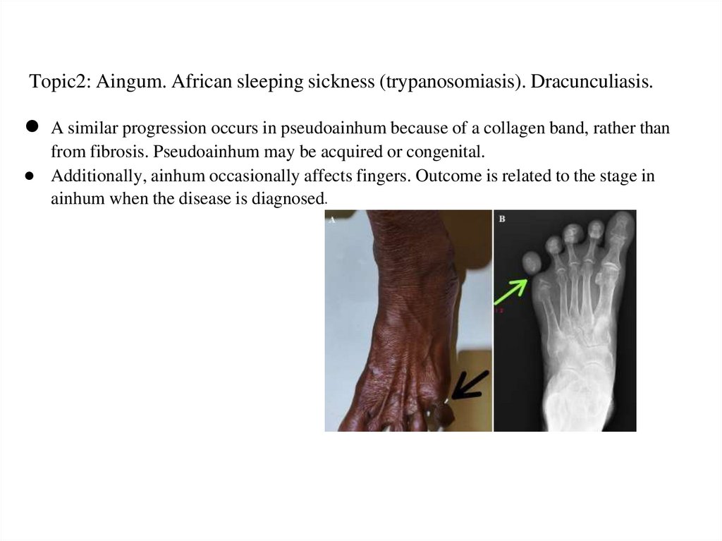 Topic2: Aingum. African sleeping sickness (trypanosomiasis). Dracunculiasis.