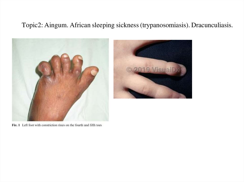 Topic2: Aingum. African sleeping sickness (trypanosomiasis). Dracunculiasis.