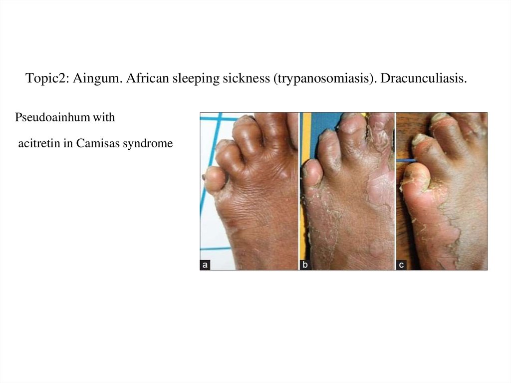 Topic2: Aingum. African sleeping sickness (trypanosomiasis). Dracunculiasis.