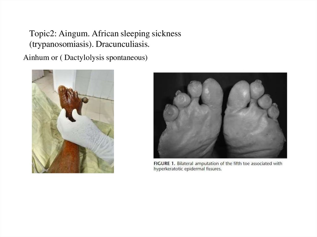 Topic2: Aingum. African sleeping sickness (trypanosomiasis). Dracunculiasis.