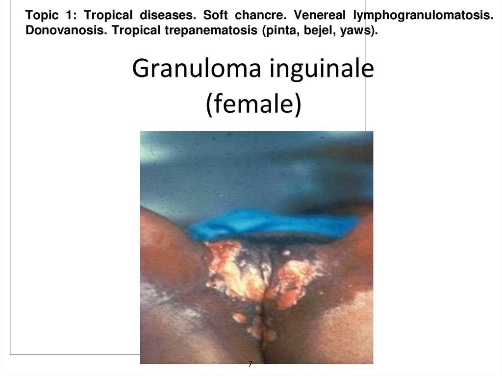 Granuloma inguinale (female)