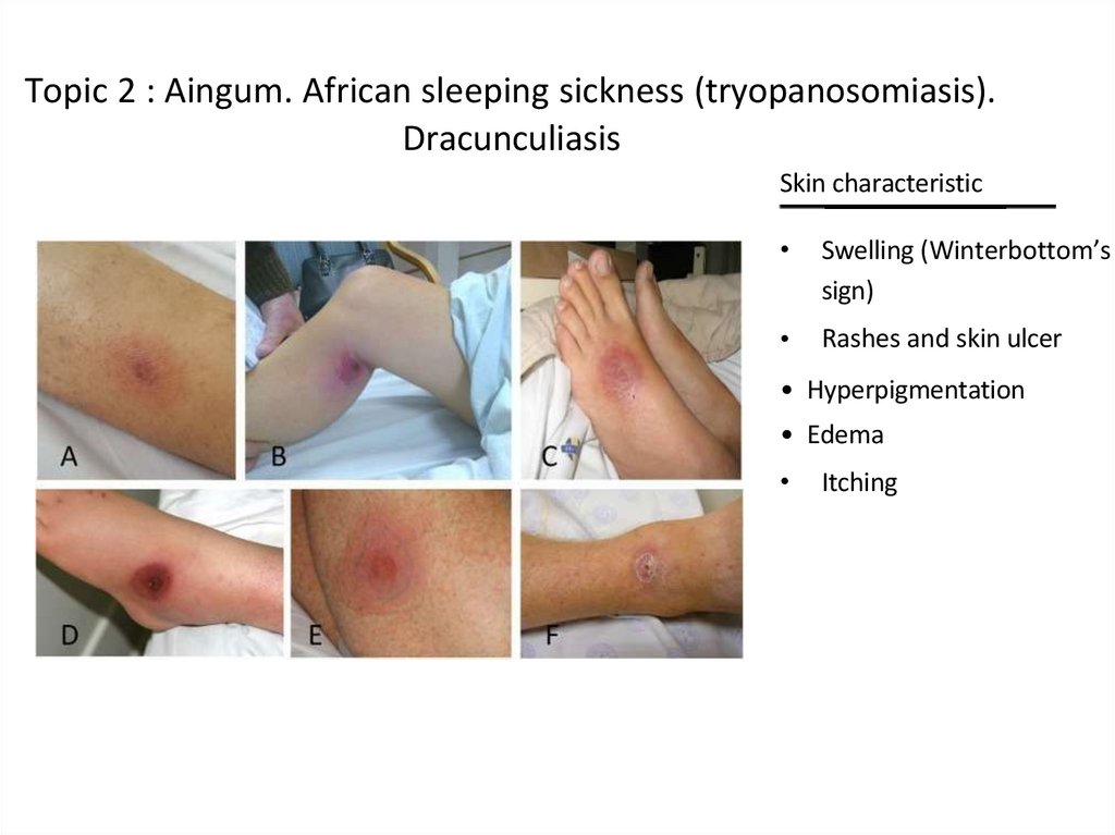 Topic 2 : Aingum. African sleeping sickness (tryopanosomiasis). Dracunculiasis