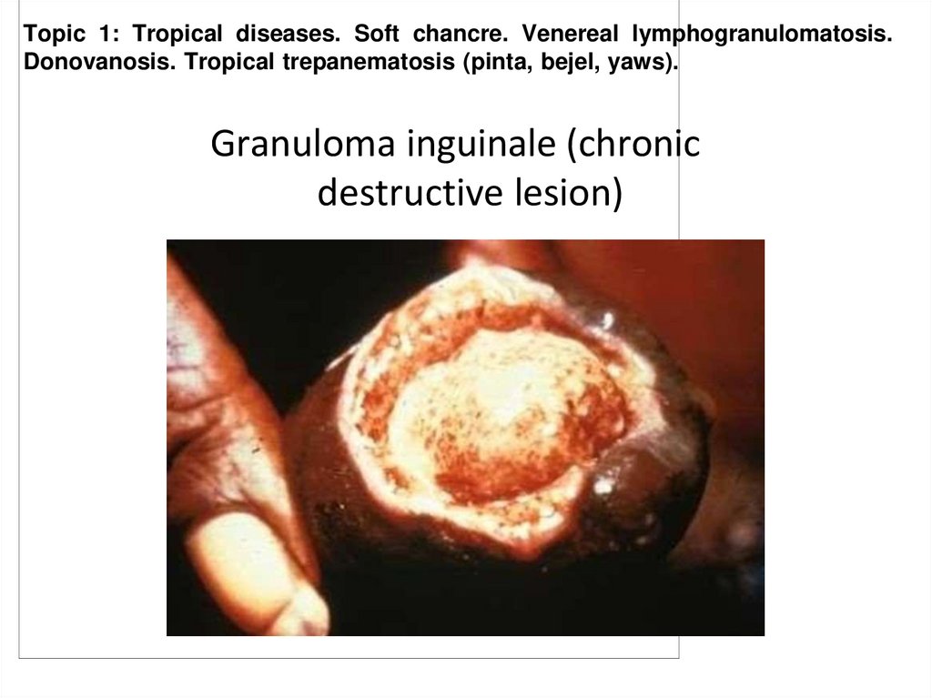 Granuloma inguinale (chronic destructive lesion)