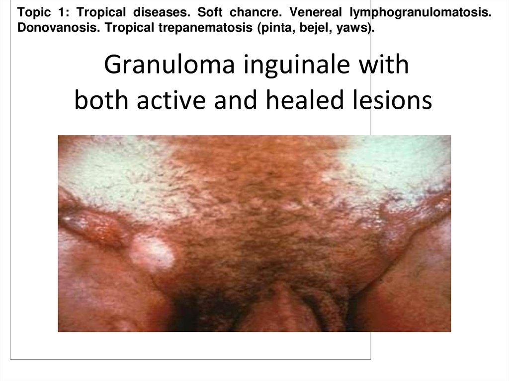 Granuloma inguinale with both active and healed lesions